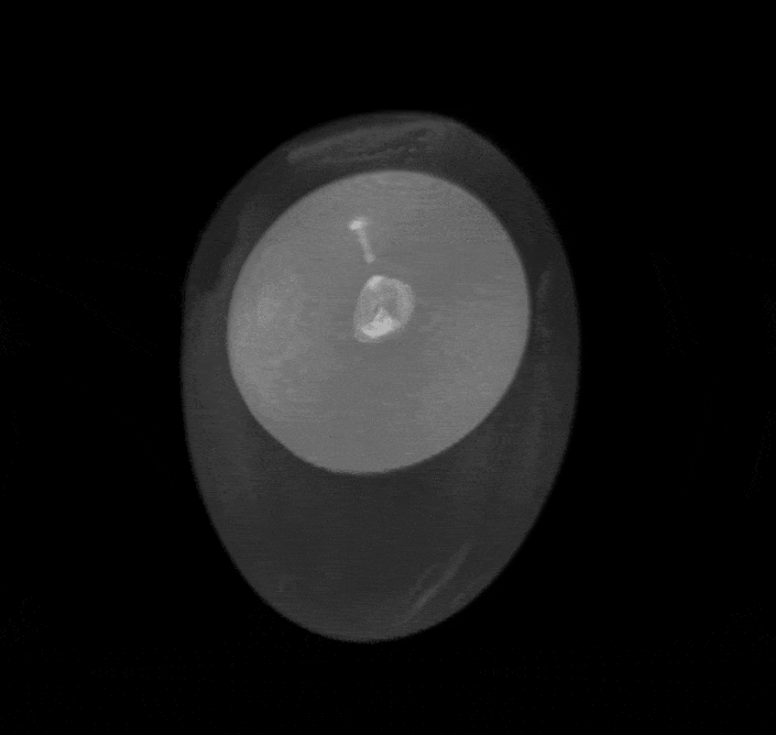Egg MRI